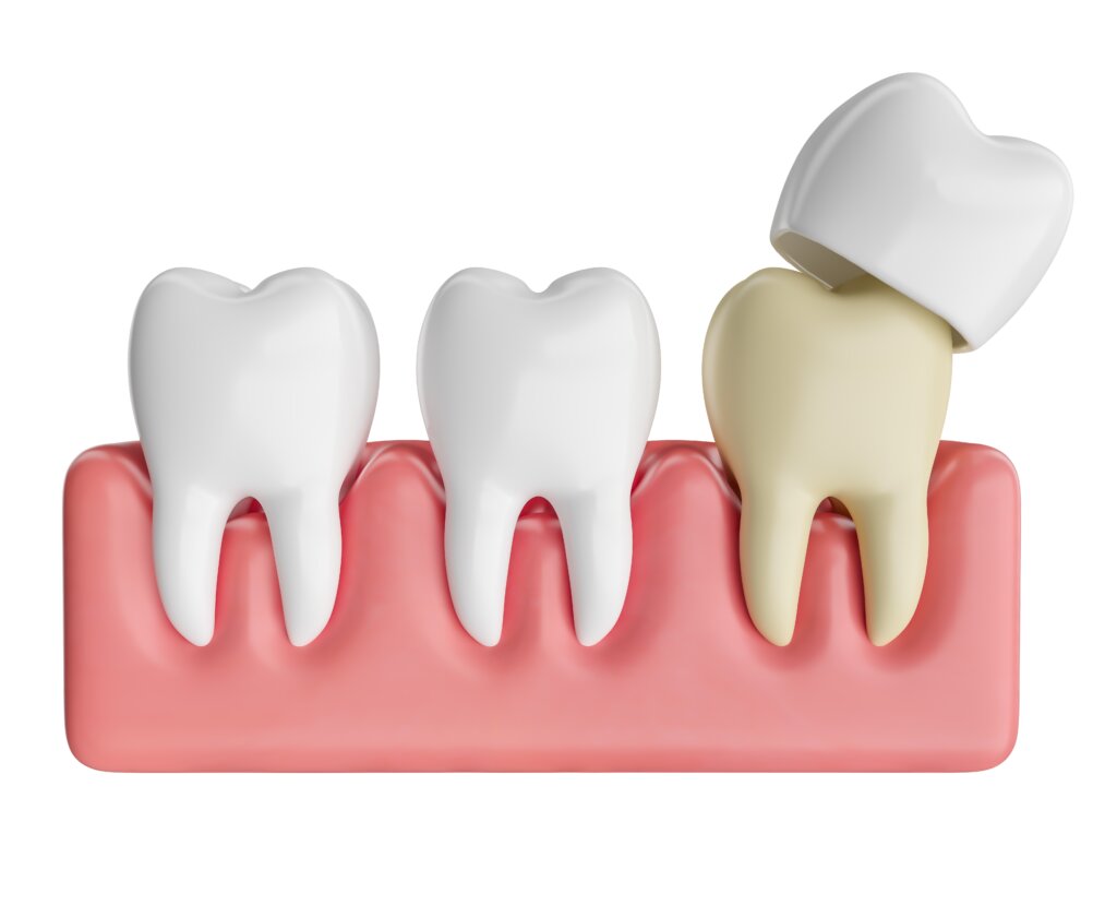 dental crowns north salt lake