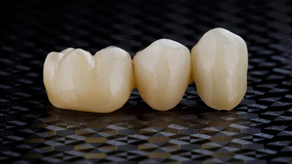 dental bridges north salt lake